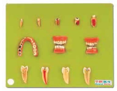 DENTAL DISEASES MODEL