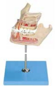 PATHOLOGIC TOOTH WITH JAW