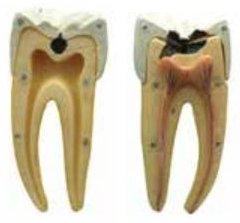 DENTAL CARIES MODEL