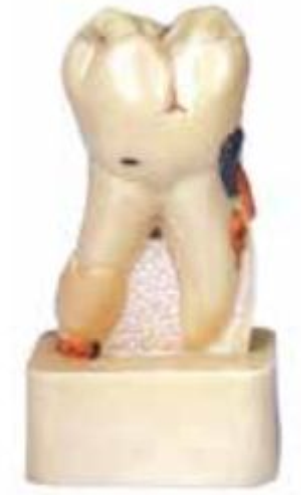 DISSECTED MODEL OF DENTAL DISEASE