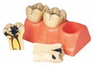 DISSECTED MODEL OF DENTAL CARIES