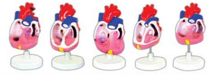 THE MODEL OF CONGENITAL HUMAN HEART DEFORMITY (SET OF 5)