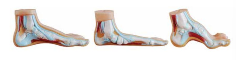 NORMAL, FLAT AND ARCHED FOOT ANATOMY