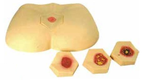 STAGE DECUBITUS ULCER CARE SIMULATOR (SOFT)